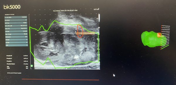 Fusion imaging during prostate biopsy planning