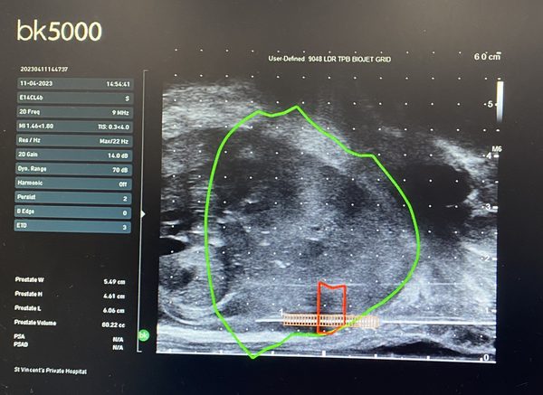 Transperineal biopsy needle guidance