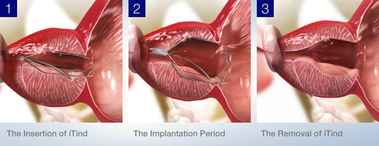 iTind procedure results