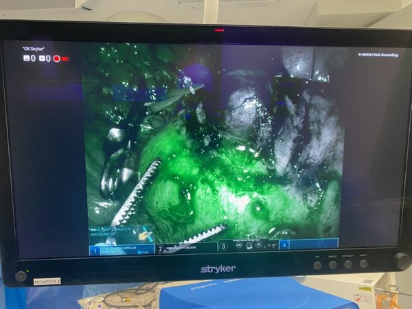 Alternate robotic partial nephrectomy ICG fluorescence view