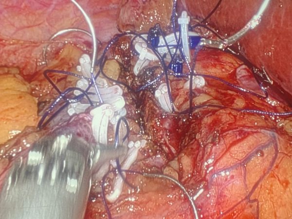 Robotic partial nephrectomy renorrhaphy detail