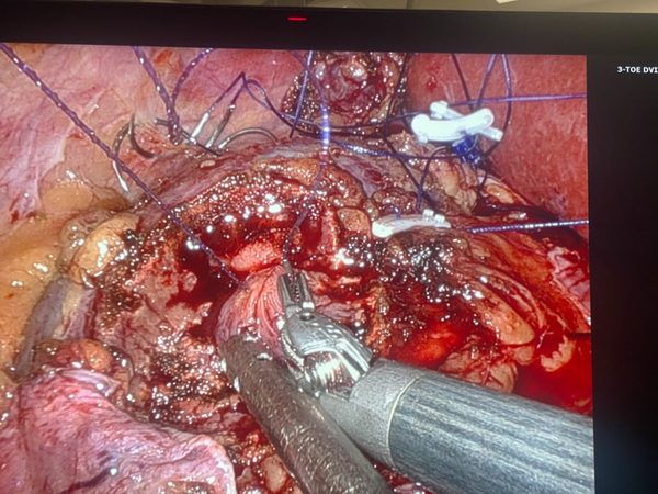 Wider robotic partial nephrectomy renorrhaphy view