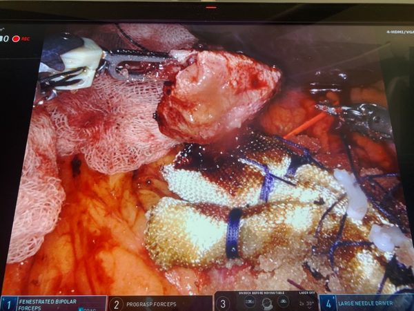 Robotic partial nephrectomy tumour specimen and bolster