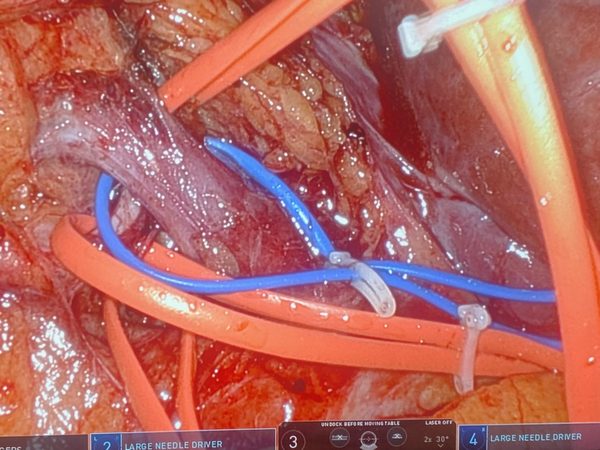 Robotic partial nephrectomy vessel control phase