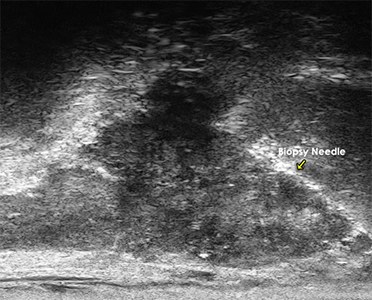 Micro-ultrasound image of the prostate with a small suspicious lesion visible as a darker region