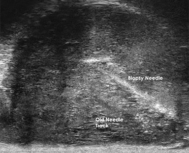 Micro-ultrasound image of the prostate with labels marking an old needle track and a new needle track from biopsies