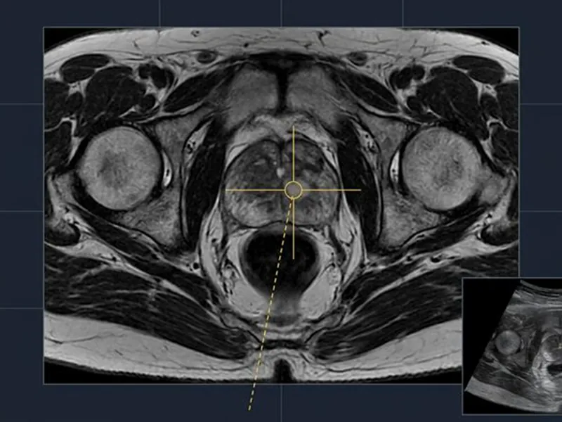 MRI-guided transperineal biopsy targeting view