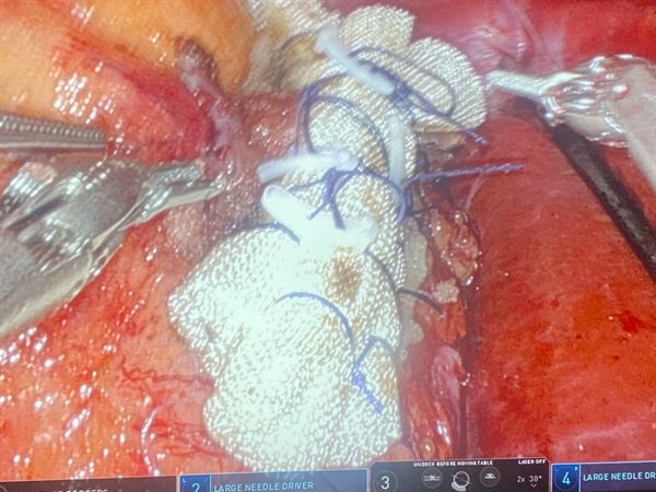 Robotic partial nephrectomy kidney parenchyma closure over a haemostatic bolster