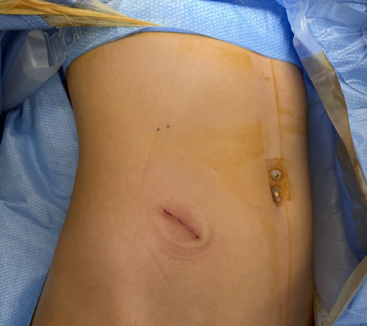 The single small incision, approximately 3 cm, at the end of the first pure single port robotic pyeloplasty