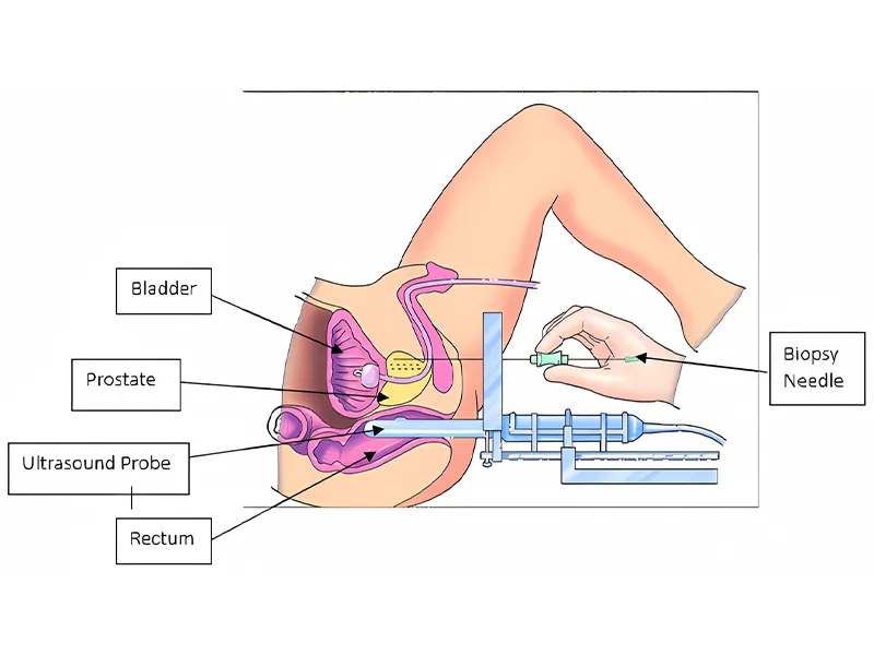 Transperineal prostate biopsy with MRI fusion targeting