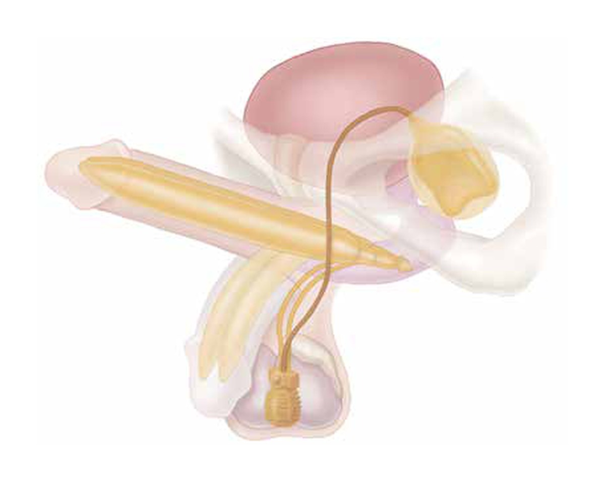 Diagram showing an inflatable penile prosthesis placed inside the penis with a scrotal pump and abdominal reservoir