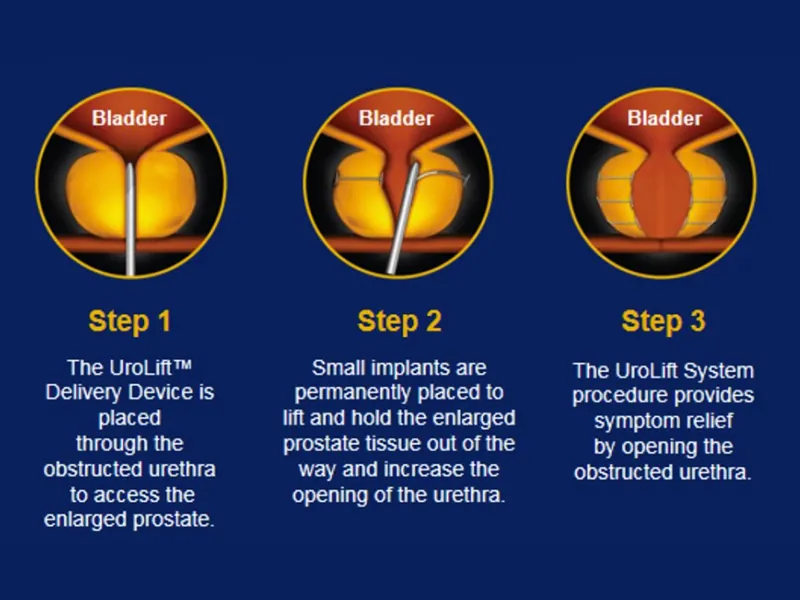 UroLift system for BPH