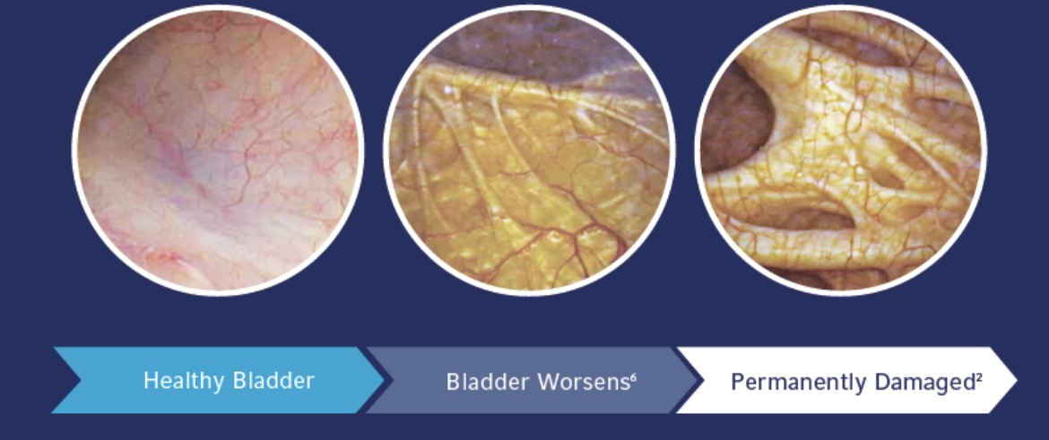 Illustration showing how prolonged bladder obstruction from untreated BPH can lead to permanent changes in bladder muscle function
